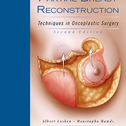 Partial Breast Reconstruction