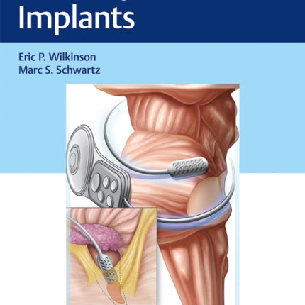 Auditory Brainstem Implants