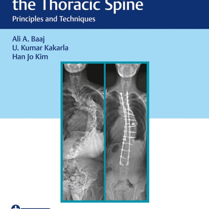 Surgery of the Thoracic Spine