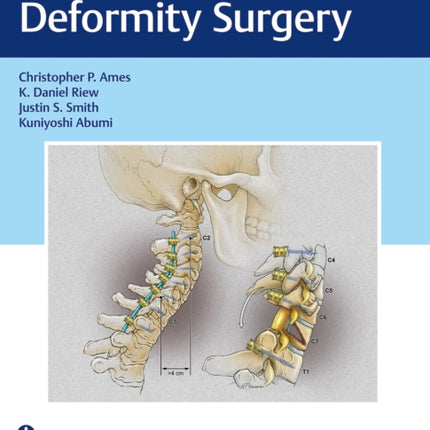 Cervical Spine Deformity Surgery