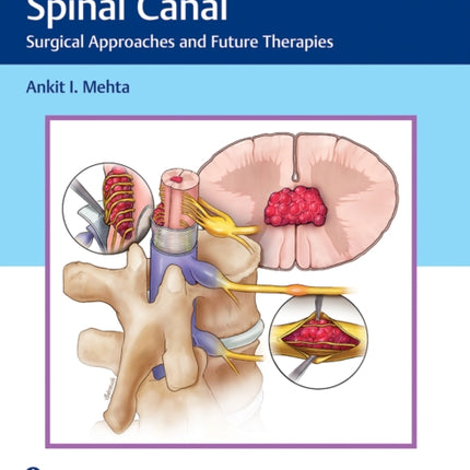 Tumors of the Spinal Canal