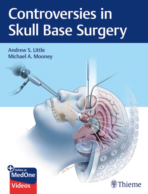 Controversies in Skull Base Surgery