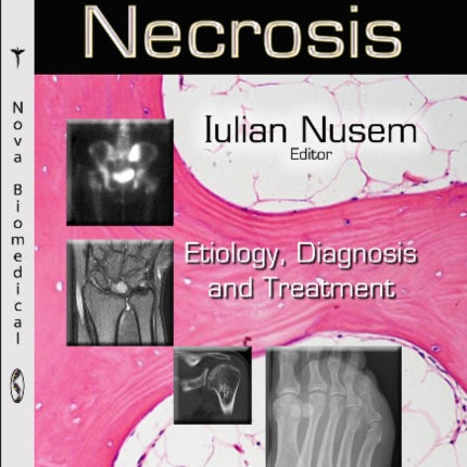 Avascular Necrosis: Etiology, Diagnosis & Treatment