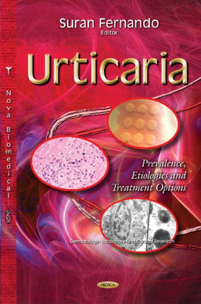Urticaria: Prevalence, Etiologies & Treatment