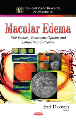 Macular Edema: Risk Factors, Treatment Options
