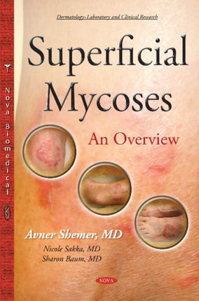 Superficial Mycoses: An Overview