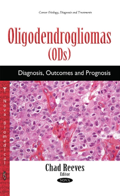 Oligodendrogliomas (ODs): Diagnosis, Outcomes &