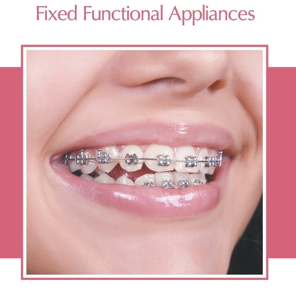 Advanced Orthodontics: Fixed Functional Appliances