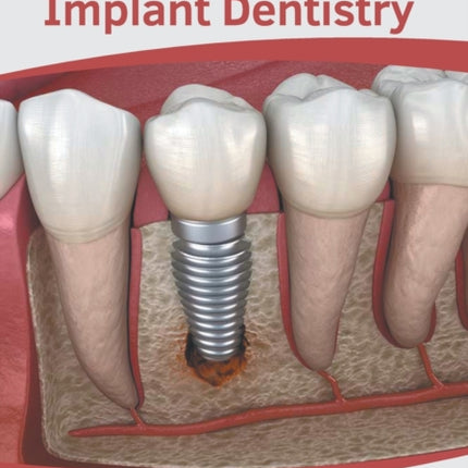 Essentials of Implant Dentistry