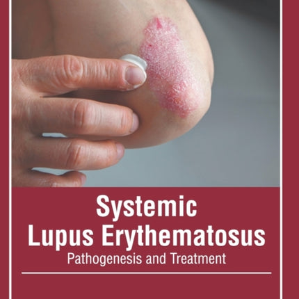 Systemic Lupus Erythematosus: Pathogenesis and