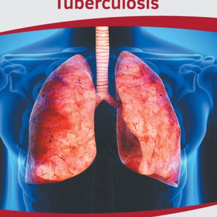 Clinical Tuberculosis