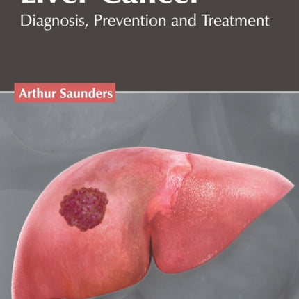 Liver Cancer: Diagnosis, Prevention and Treatment