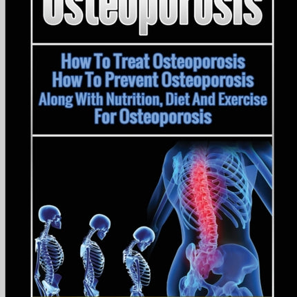 Osteoporosis: How To Treat Osteoporosis: How To Prevent Osteoporosis: Along With Nutrition, Diet And Exercise For Osteoporosis