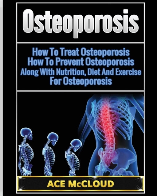 Osteoporosis: How To Treat Osteoporosis: How To Prevent Osteoporosis: Along With Nutrition, Diet And Exercise For Osteoporosis