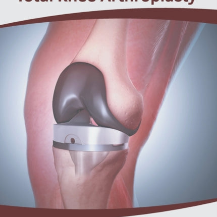 Essentials in Total Knee Arthroplasty