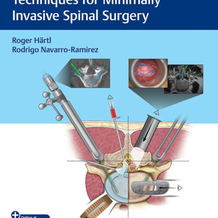 Essential Step-by-Step Techniques for Minimally Invasive Spinal Surgery