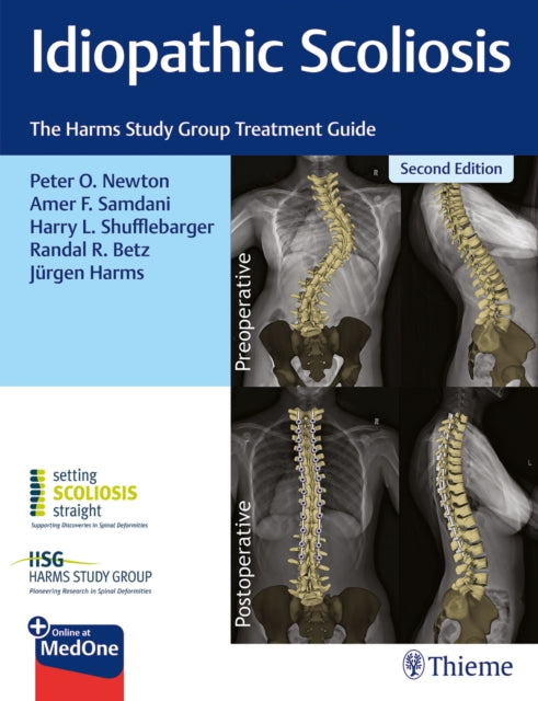 Idiopathic Scoliosis: The Harms Study Group Treatment Guide