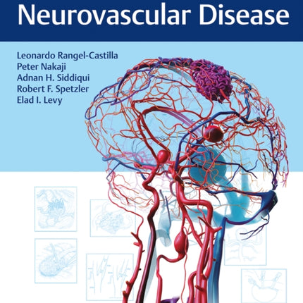 Decision Making in Neurovascular Disease