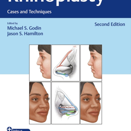 Rhinoplasty
