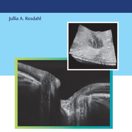 Optical Coherence Tomography in Glaucoma