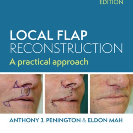 Local Flap Reconstruction