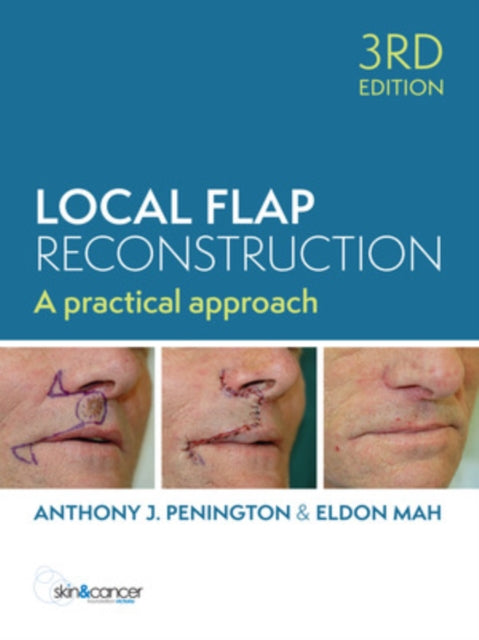 Local Flap Reconstruction