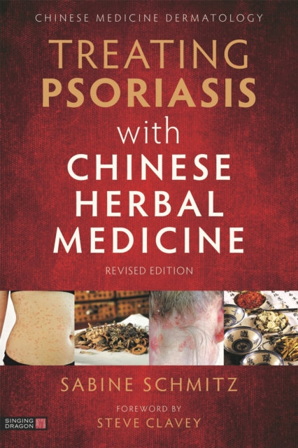 Treating Psoriasis with Chinese Herbal Medicine (Revised Edition): A Practical Handbook