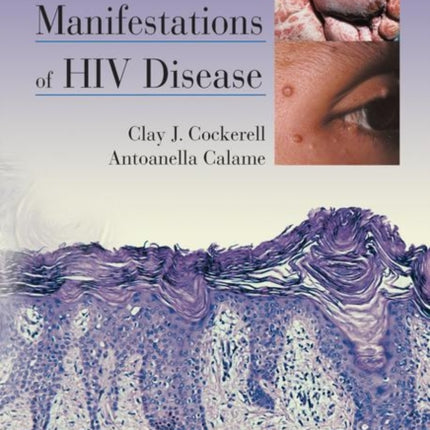 Cutaneous Manifestations of HIV Disease