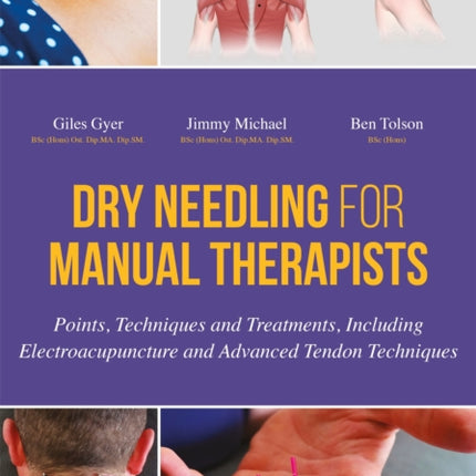 Dry Needling for Manual Therapists: Points, Techniques and Treatments, Including Electroacupuncture and Advanced Tendon Techniques