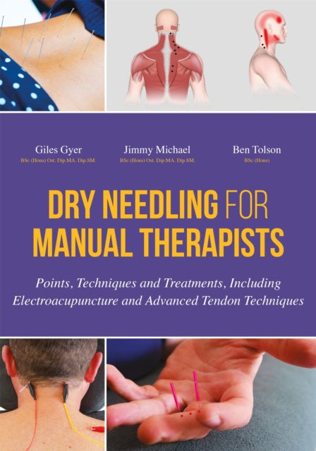 Dry Needling for Manual Therapists: Points, Techniques and Treatments, Including Electroacupuncture and Advanced Tendon Techniques