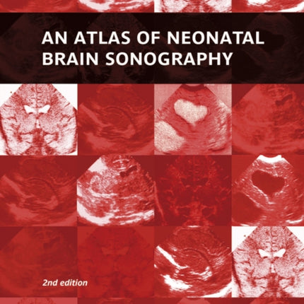 An Atlas of Neonatal Brain Sonography