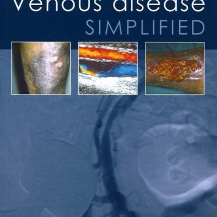 Venous Disease Simplified