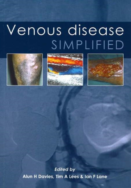 Venous Disease Simplified