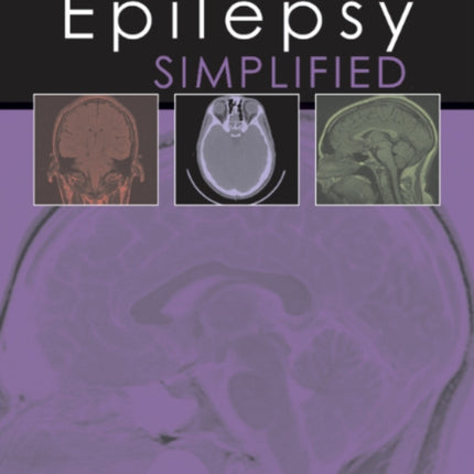 Epilepsy Simplified