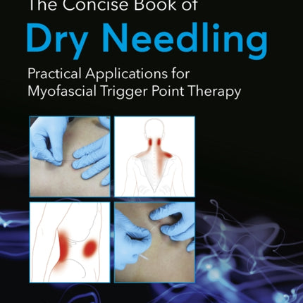 The Concise Book of Dry Needling: A Practitioner's Guide to Myofascial Trigger Point Applications