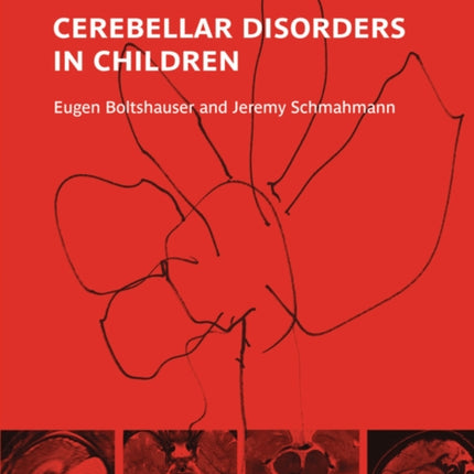 Cerebellar Disorders in Children