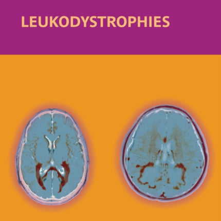 Leukodystrophies