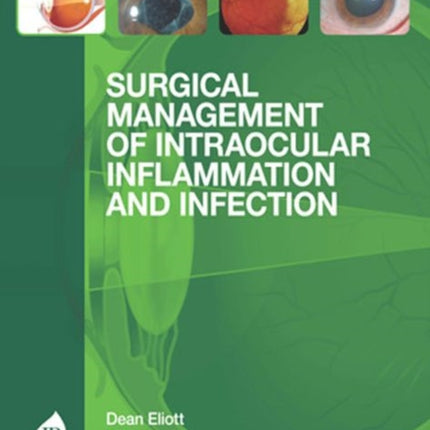 Surgical Management of Intraocular Inflammation and Infection