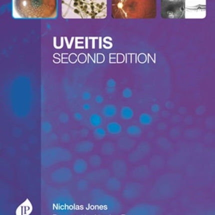 Uveitis