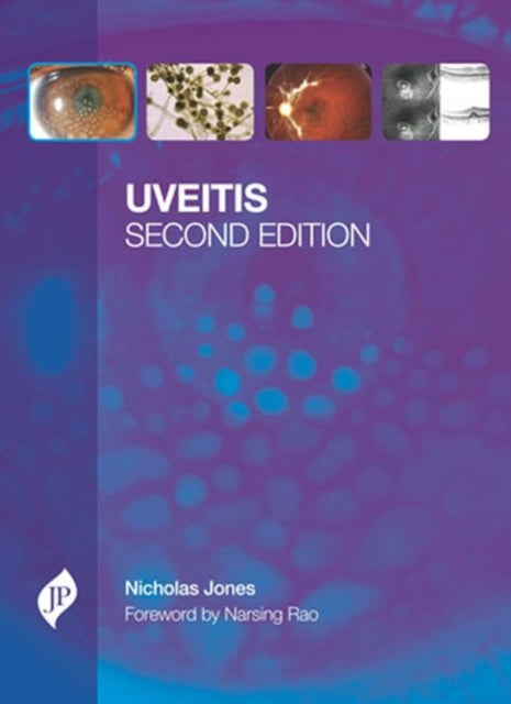 Uveitis