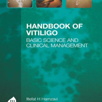 Handbook of Vitiligo: Basic Science and Clinical Management