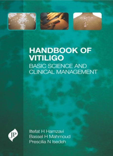 Handbook of Vitiligo: Basic Science and Clinical Management