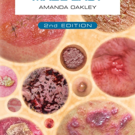 Dermatology Made Easy, second edition