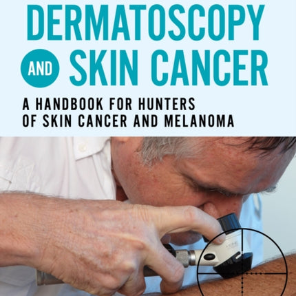 Dermatoscopy and Skin Cancer, updated edition: A handbook for hunters of skin cancer and melanoma