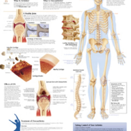 Osteoarthritis Laminated Poster