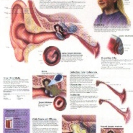 Middle Ear Infections Paper Poster