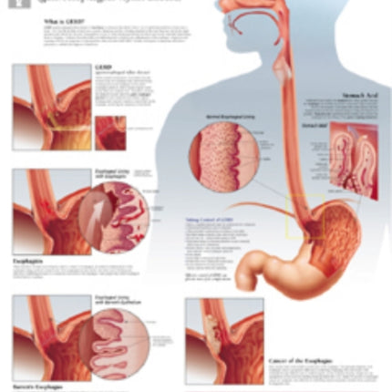 Understanding GERD (Gastroesophageal Reflux Disease) Paper Poster