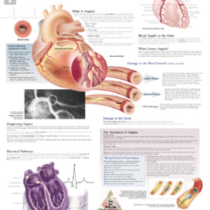 Understanding Angina Paper Poster