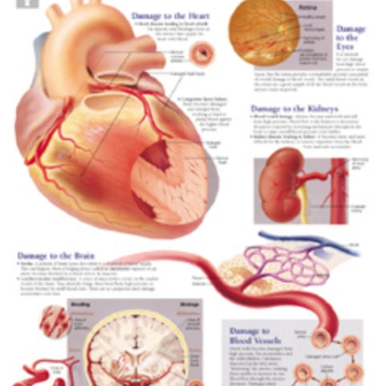 Effects of Hypertension Laminated Poster