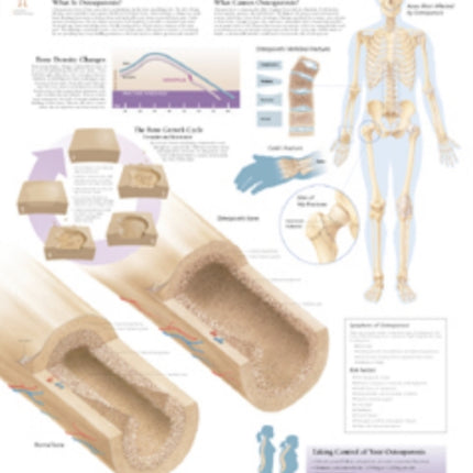 Understanding Osteoporosis Paper Poster